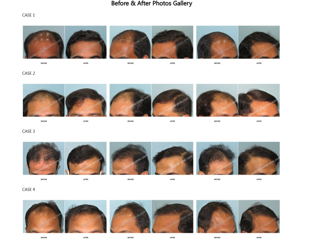 Midas Hair Clinic